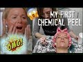 MY FIRST CHEMICAL PEEL EXPERIENCE I BRITECLARKE