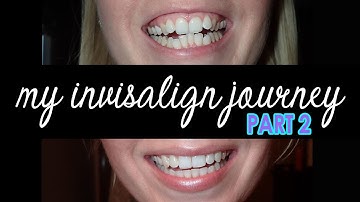 My Invisalign Journey PART 2 | Halfway Through Straightening My Teeth With Invisalign Process