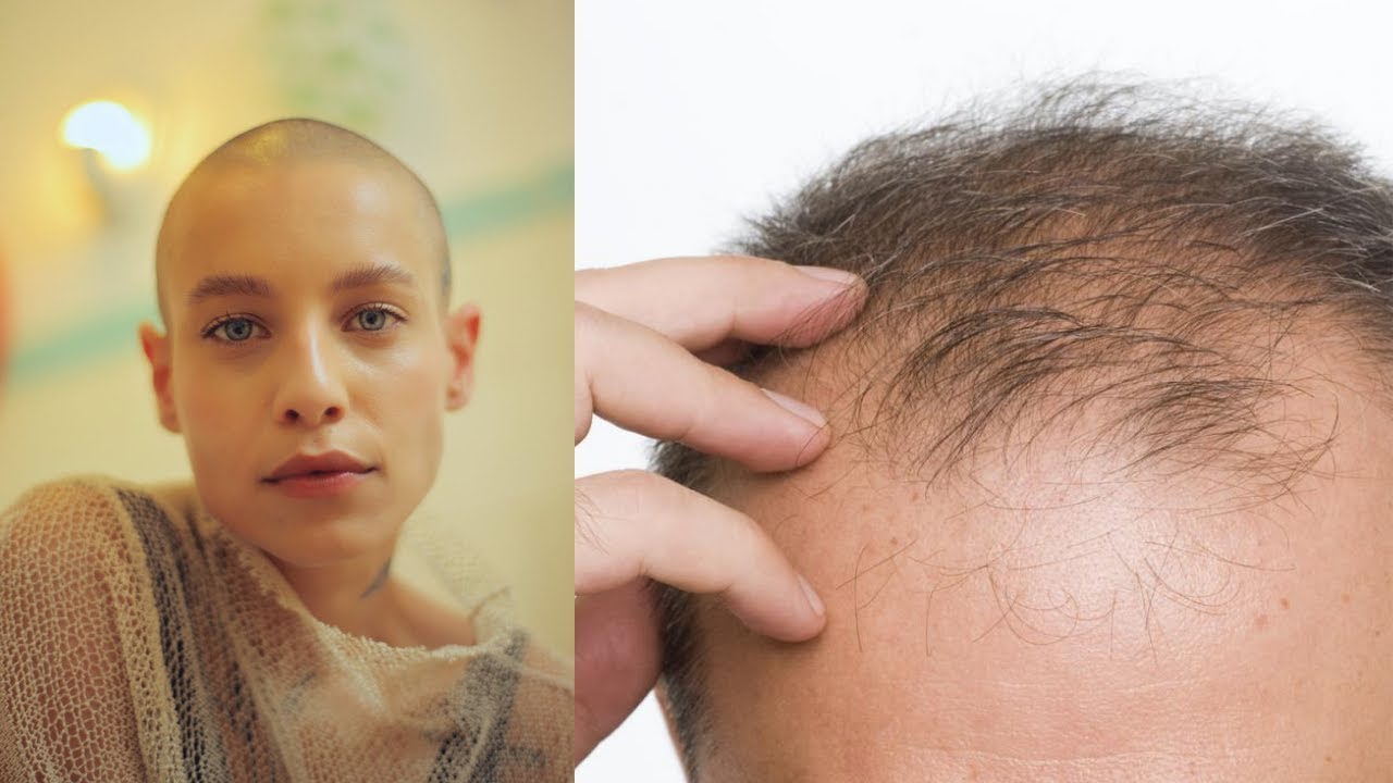 Natural Ways To Prevent Hereditary Hair Loss YouTube