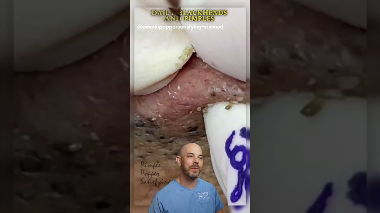 TONS of blackheads get poked out in this video! 📌( credit: @pimplepoppersatisfying on TT)  #doctor