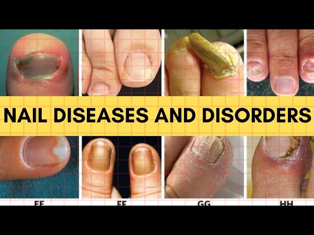 Common Nail Disorders: Causes, Symptoms, and Treatments