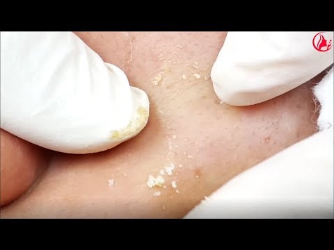 Video Cách điều trị mụn ẩn, mụn cám - Hiền Vân spa! Học nghề... - youtube