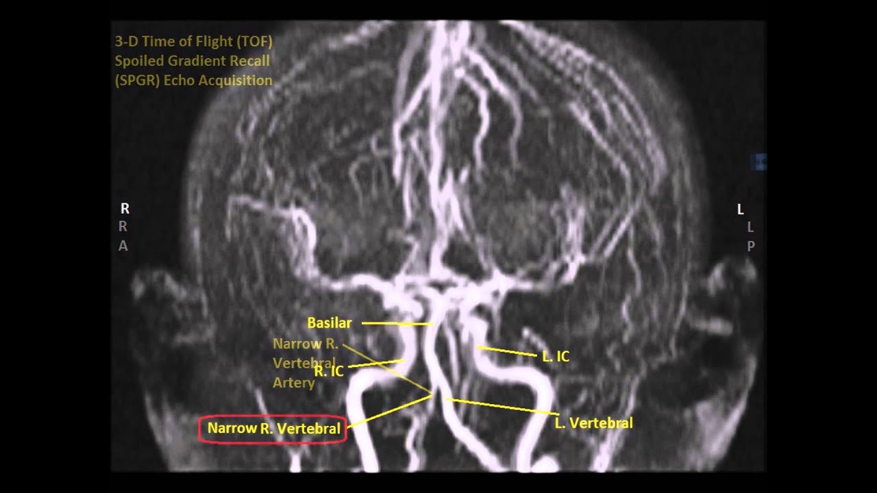 Abnormal Right Vertebral Artery 3-D MRA Sequence-Sanjoy Sanyal - YouTube