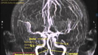 Abnormal Right Vertebral Artery 3-D MRA Sequence-Sanjoy Sanyal