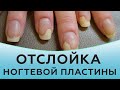 Отслойка ногтей | Отслойка ногтевой пластины