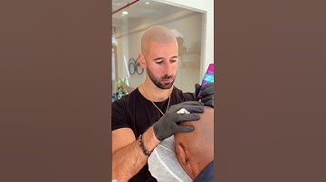 Scalp micropigmentation in action ⚡️ #hairlosstreatment #hairtattoo #scalpmicropigmentation