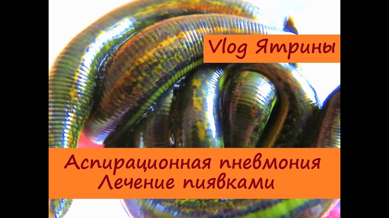 Аспирационная пневмония при инсульте, лечение пиявками - YouTube