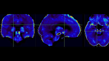 High-Resolution 3D Ultra-Short Echo Time MRI with Rosette k-Space for Brain Iron Content Mapping