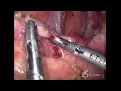 Vídeo: Cirurgia Para Doença De Crohn: Colectomias E Ressecção De Cólon