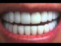 Get Perfectly Straight Teeth―∎ affirmations | Cure Overbite, Underbite & Crossbite