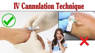 Intravenous Cannulation Technique Iv Cannula Procedure