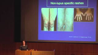 Lupus, The Skin & Hair  Dr Abby Macbeth (East Anglia Lupus Info Day, Oct 2013)