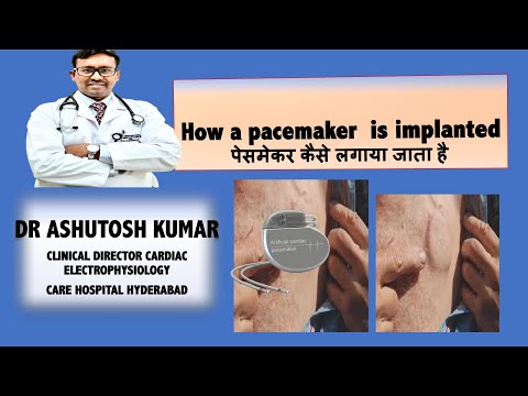 Video: Kam dali kardiostimulátor?
