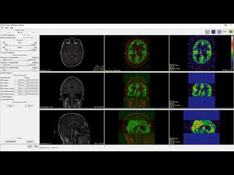 Analyze 14.0 - Register: Intermodality Registration of PET to MRI