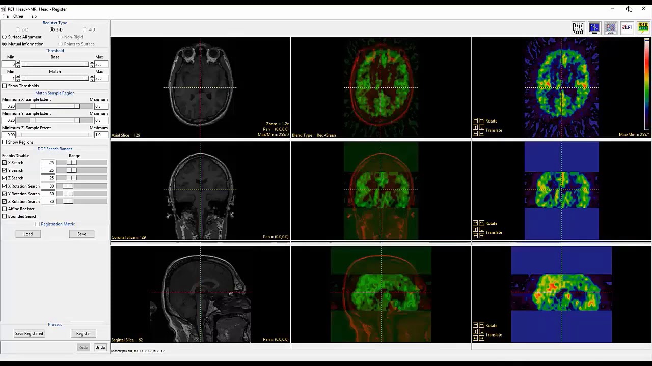 Analyze 14.0 - Register: Intermodality Registration of PET to MRI - YouTube