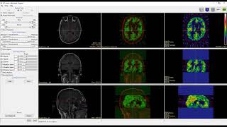 Analyze 14.0 - Register: Intermodality Registration of PET to MRI