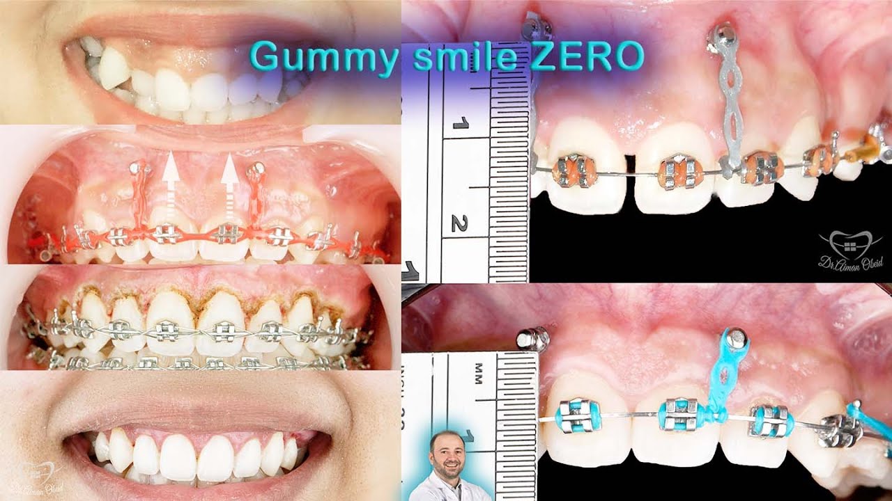 Gummy smile ZERO, treatment done by braces, TADs miniimplantes & laser