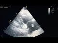 Biatrial thrombus connected through PFO + pulmonary embolism