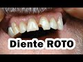 𝐃𝐈𝐄𝐍𝐓𝐄 𝐑𝐎𝐓𝐎 🦷  Casos Reales con el Doctor Usón Reconstrucción Dental Rápida