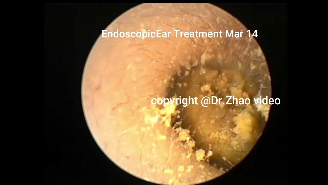 Ear wax removal dr zhao