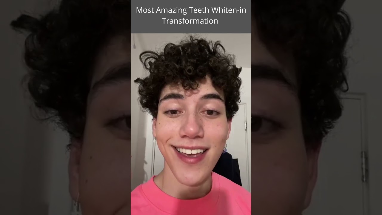 Most Amazing Teeth Whiten-in Transformation/Motivation by Olliesinha