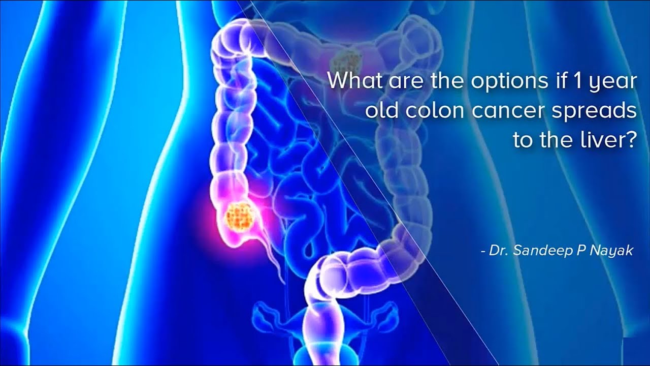 What are the options if a 1 year old Colon Cancer spreads to the liver ...