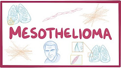 Mesothelioma - causes, symptoms, diagnosis, treatment, pathology