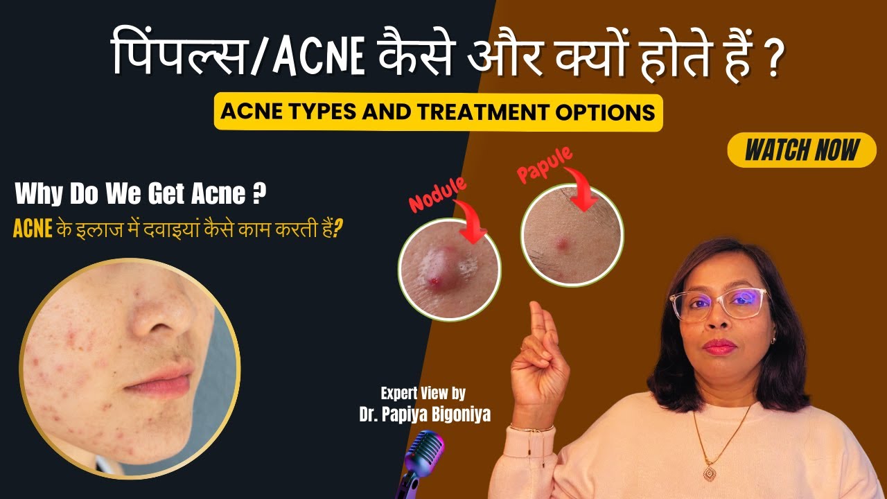 पिंपल्स/Acne कैसे और क्यों होते हैं ?...ACNE/मुंहासों की समस्या को हल करने का तरीका जानें