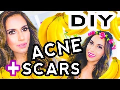 (DIY) Best Acne Treatment | Acne Scars Skin Care Routine, How to Get Flawless Skin | Himani Wright