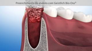 Coágulo do siso dentes estourou