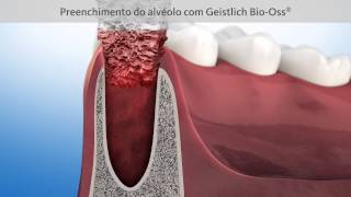 Tratamento de preservação óssea após extração dentária