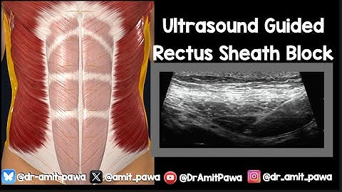 New Rectus Sheath Block Video with Actual Block Included!