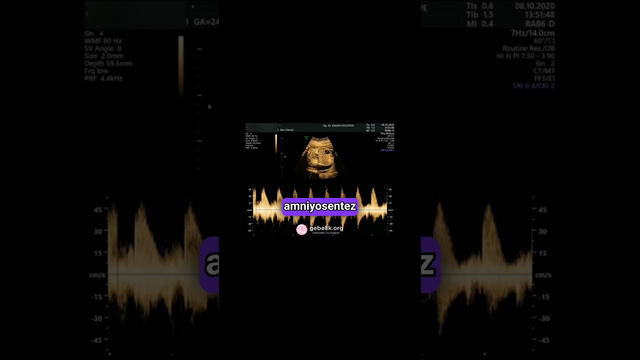 Anne karnında bebekte multikistik displastik böbrek nasıl görünür, bebek için ne riski var? Tedavi?