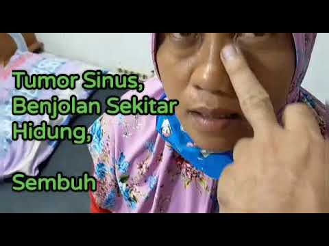 Tempat terapi pengobatan tumor atau kanker, tumor di wajah, tumor sekitar hidung sinus sembuh