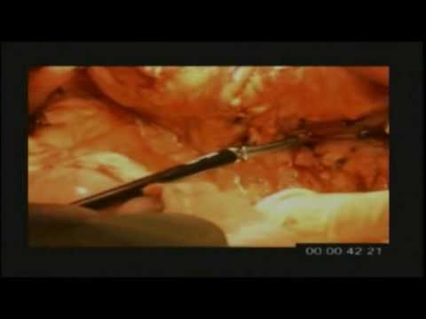 Total Laparoscopic Whipple Resection