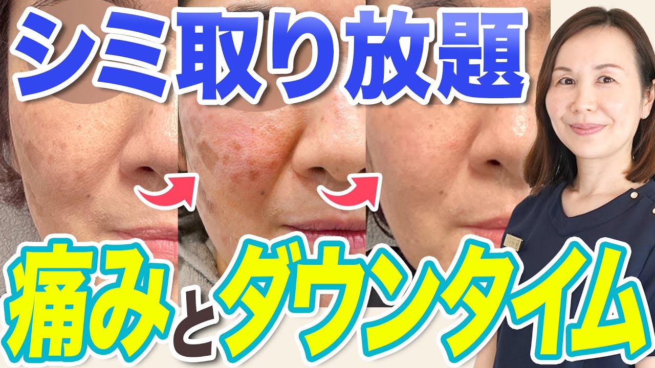 【ピコレーザー】徹底シミ取り！施術や経過について解説します