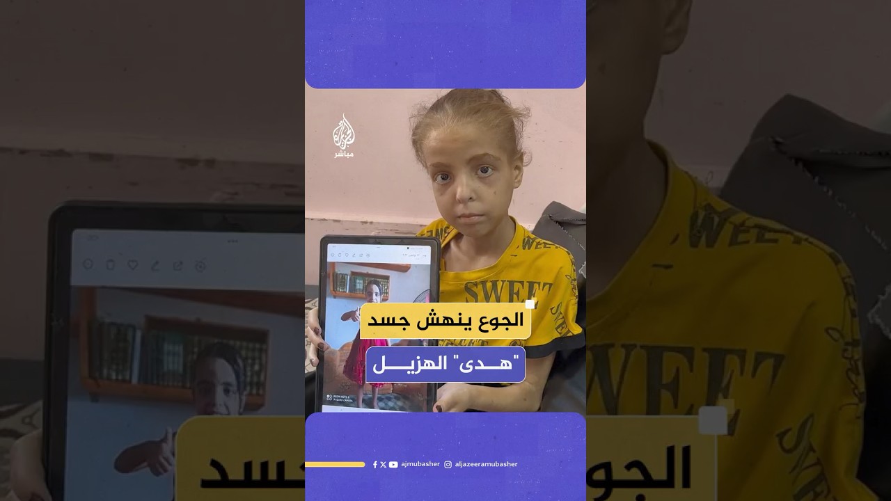 هدى أبو النجا طفلة فلسطينية في غزة تعاني نقصا حادا في الوزن جراء سوء التغذية