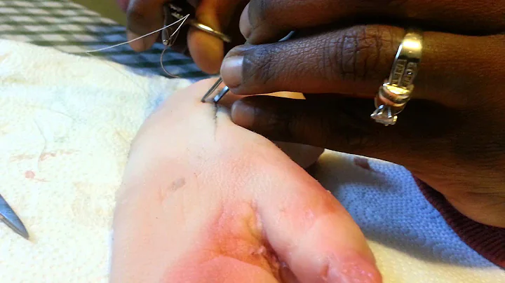suturing for NURS 6211 by Rosalyn Anderson, RN BSN