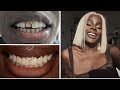 HOW I FIXED MY TEETH WITHOUT VENEERS! ALL QUESTIONS ANSWERED! + VIDEOS