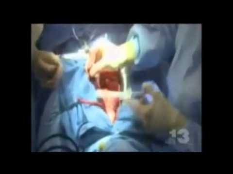 Vídeo: Cirugía A Corazón Abierto: Riesgos, Procedimiento Y Preparación