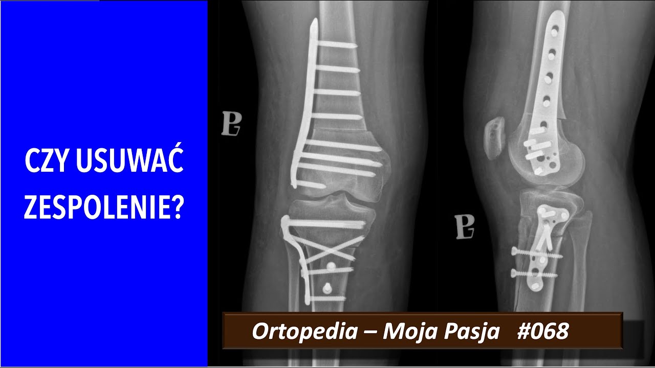 Czy trzeba usuwać zespolenie?