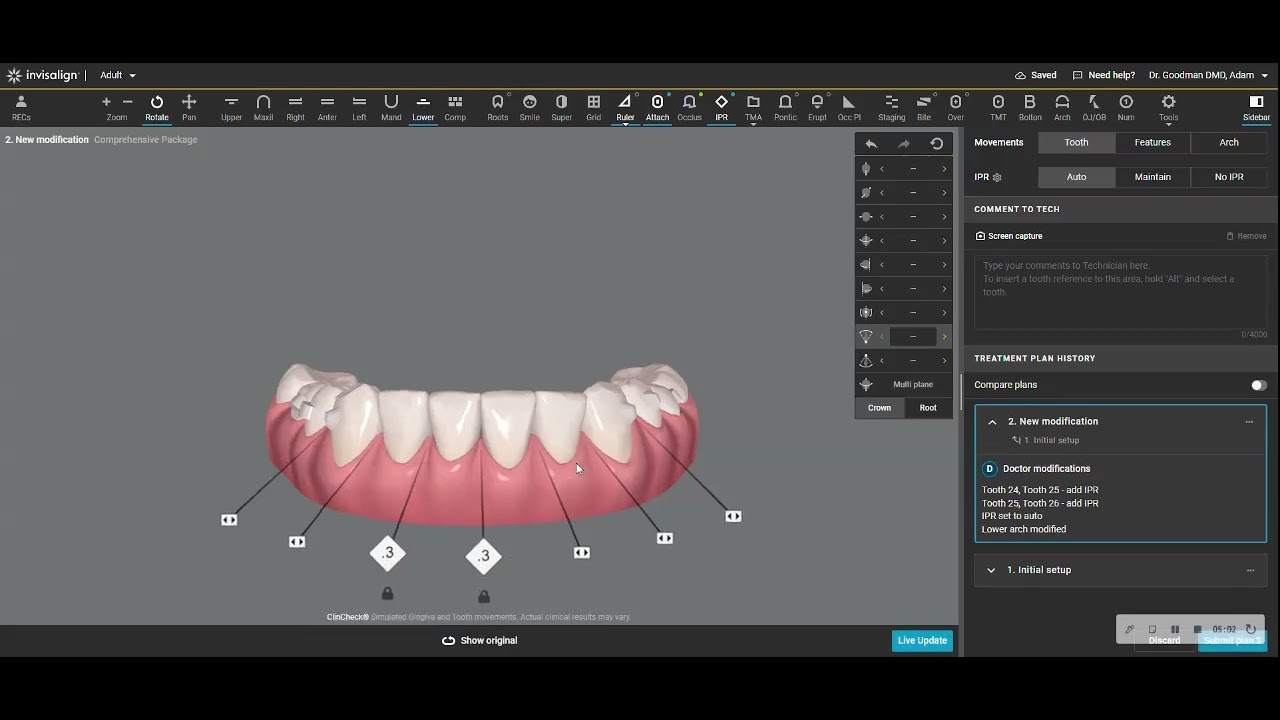 Big Mistake with an Invisalign Treatment Plan, every GP who provides ...