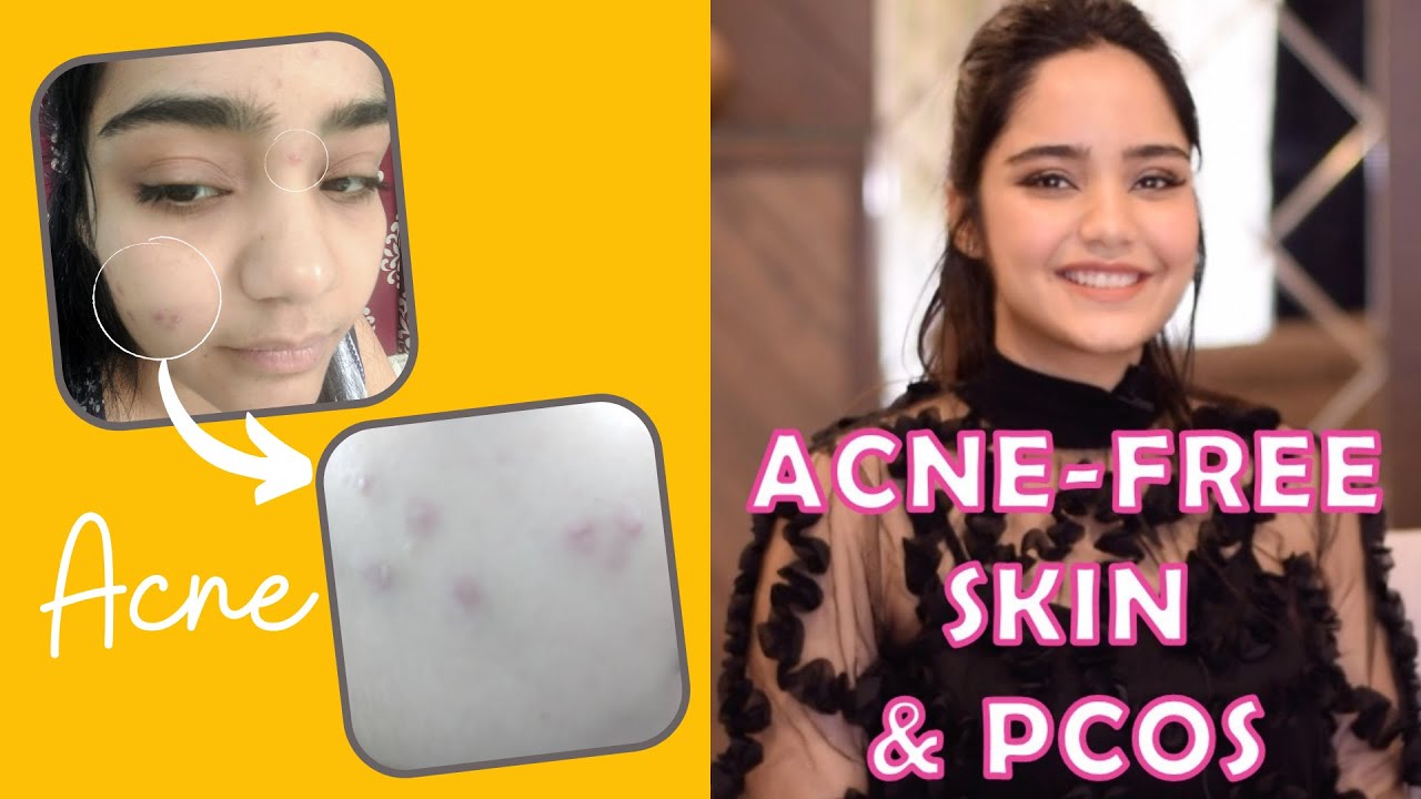 Download How I got rid of my Acne | PCOS | Hormonal Acne | Pimples