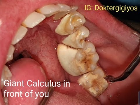 scraping black stuff off teeth calculus scraping black stuff off teeth calculus