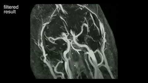 Variational Denoising of MRI datasets