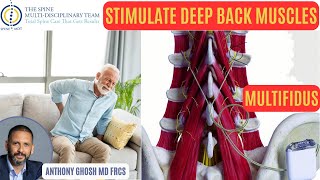 Multifidus Muscle Stimulation: A New Way to Treat Chronic Back Pain