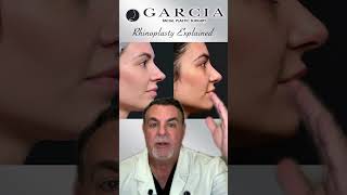 Kaitland's Rhinoplasty Explained