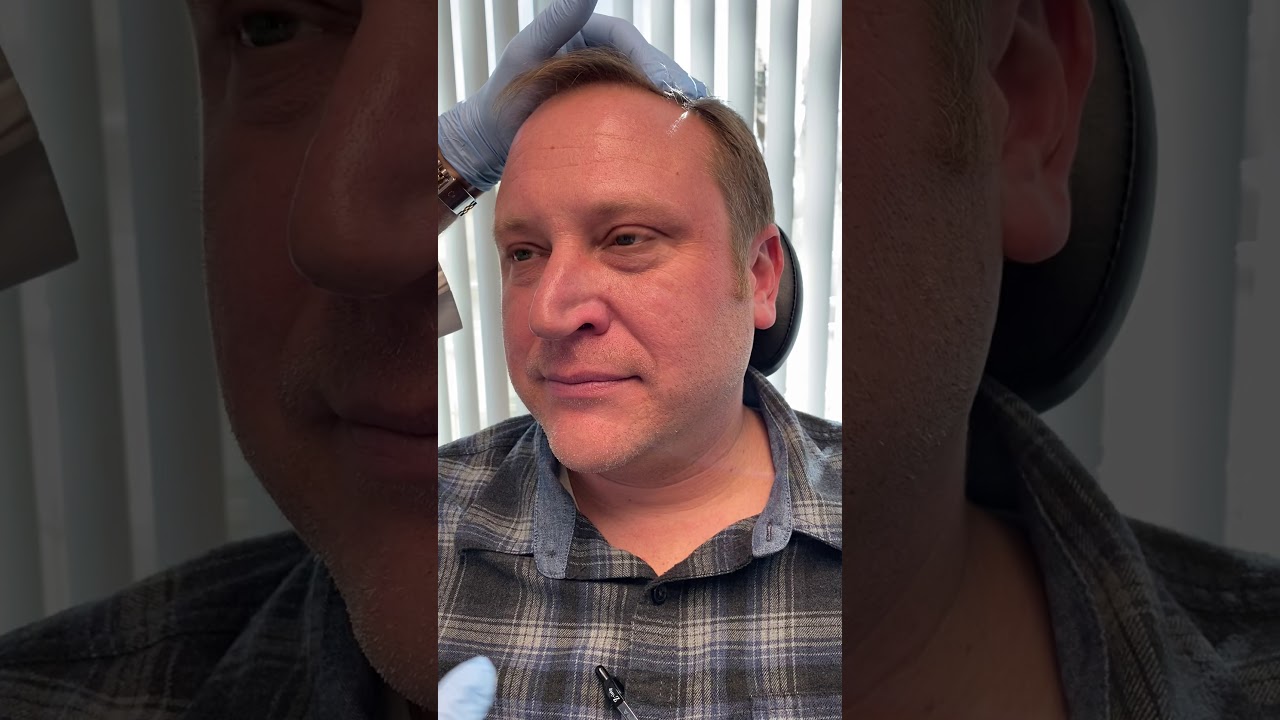 Nasal Valve Collapse-How To Diagnose