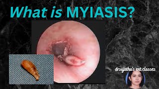 175.What is Myiasis?  #Myiasis in human  #Myiasis of the ear #maggothuman