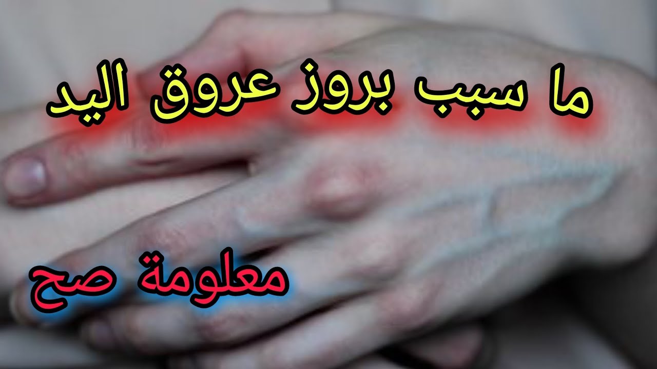 ما سبب بروز عروق اليد - YouTube